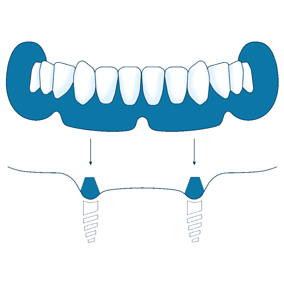 Implanted Dentures